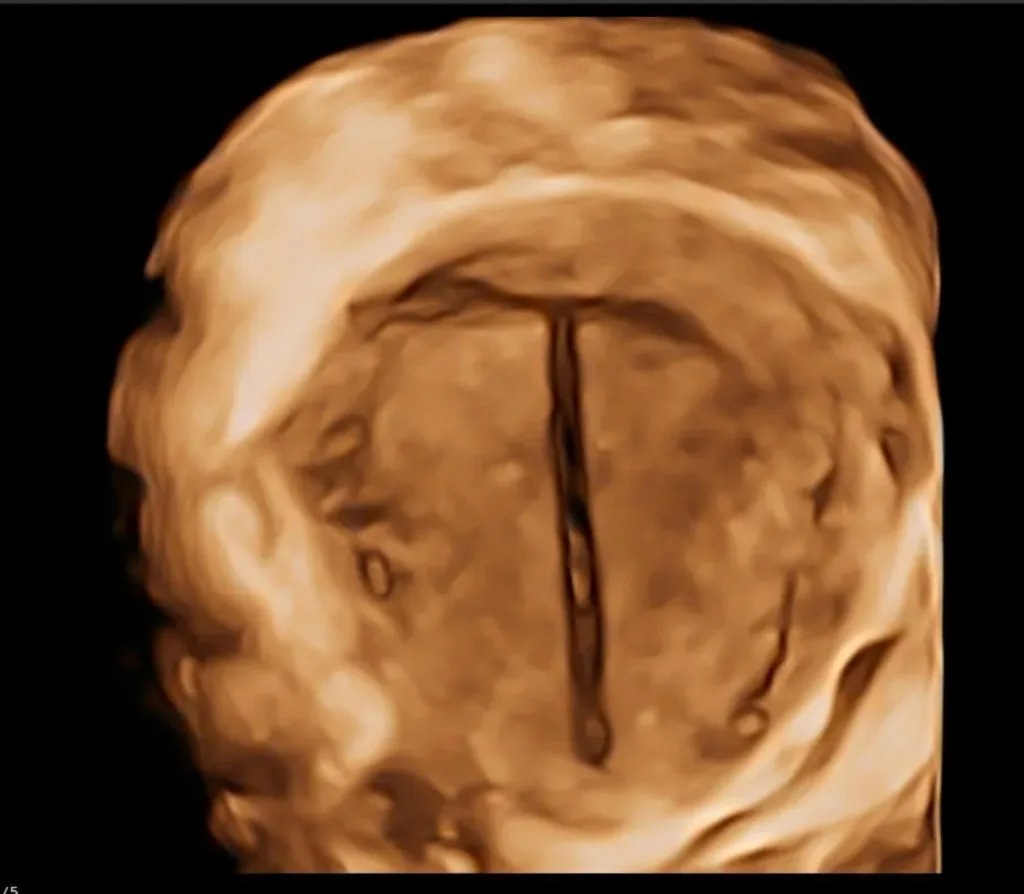 Ecografía 3D de útero con dispositivo intrauterino