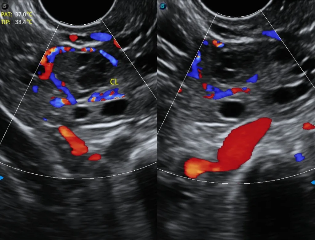 Ecografía con Doppler color mostrando corpus lúteo y flujo vascular ovárico
