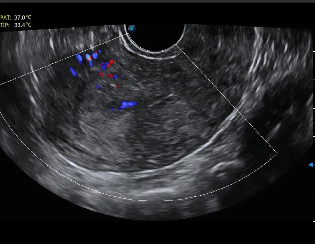 Ecografía con Doppler color para evaluación de adenomiosis en mapeo pélvico