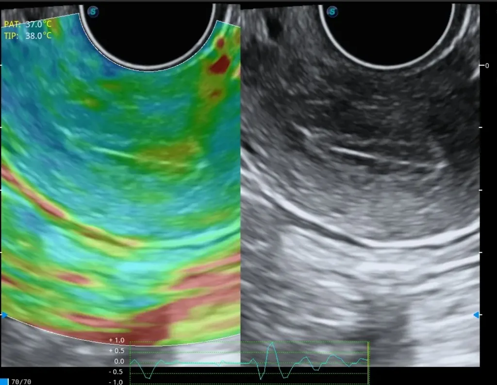 Elastografía por ultrasonido para mapeo de endometriosis