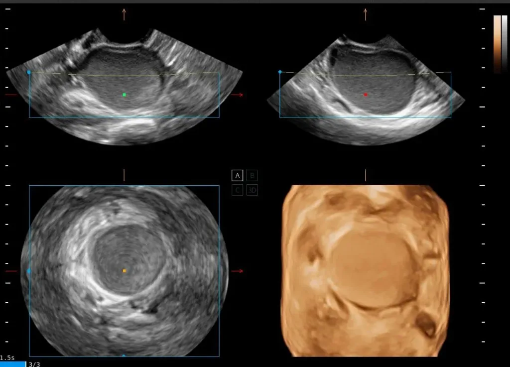 Endometrioma en planos 2D y reconstrucción volumétrica 3D