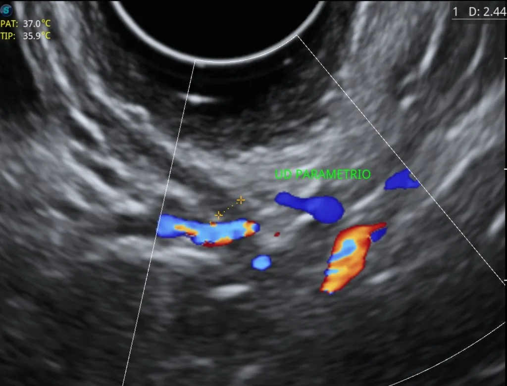 Ecografía Doppler color del parametrio lateral mostrando el uréter en mapeo de endometriosis