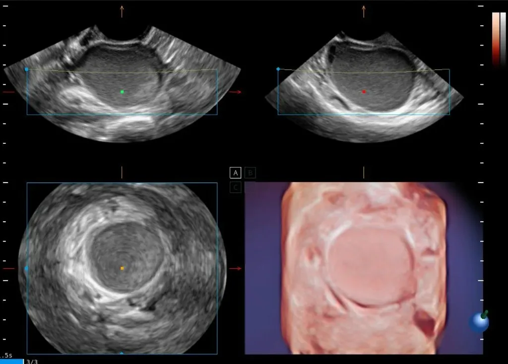 Endometrioma en ultrasonido 2D y reconstrucción 3D en cuatro planos