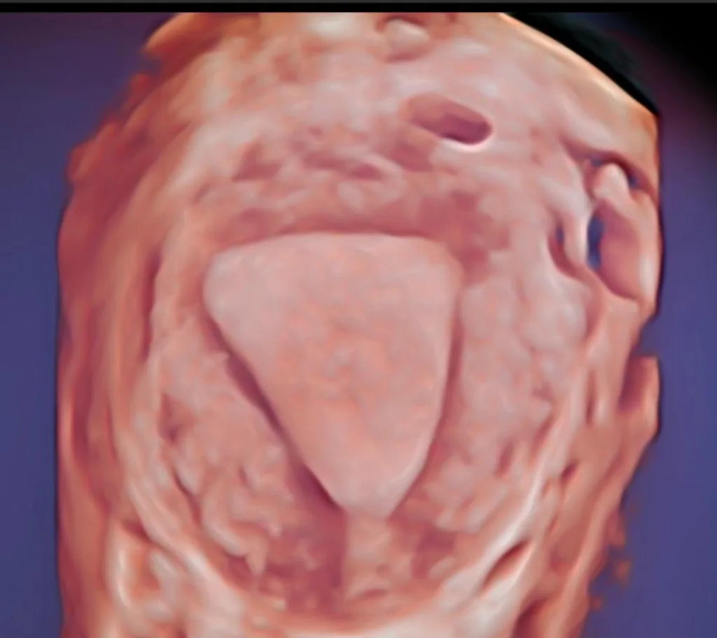Reconstrucción 3D por ultrasonido de útero mostrando cavidad uterina y miometrio