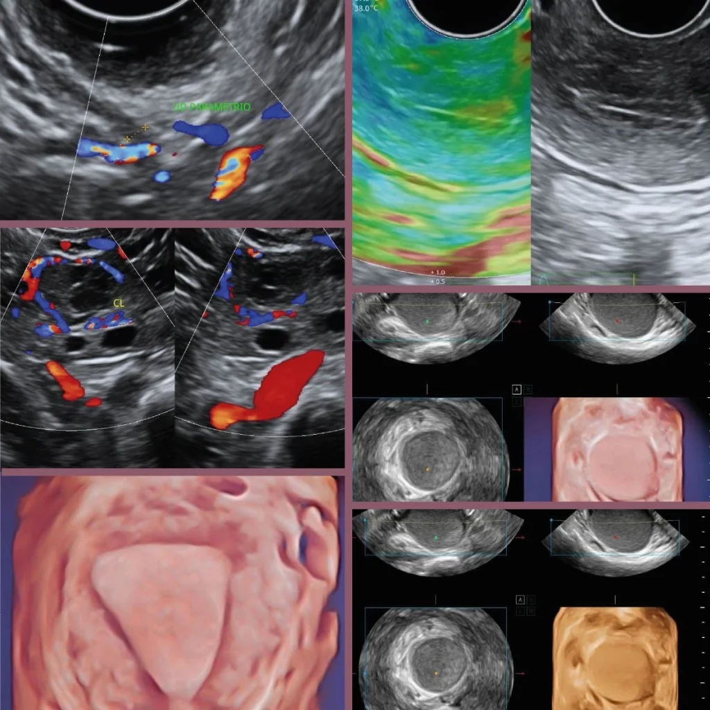 Collage de ultrasonido 2D, Doppler, elastografía y reconstrucción 3D para mapeo ecográfico